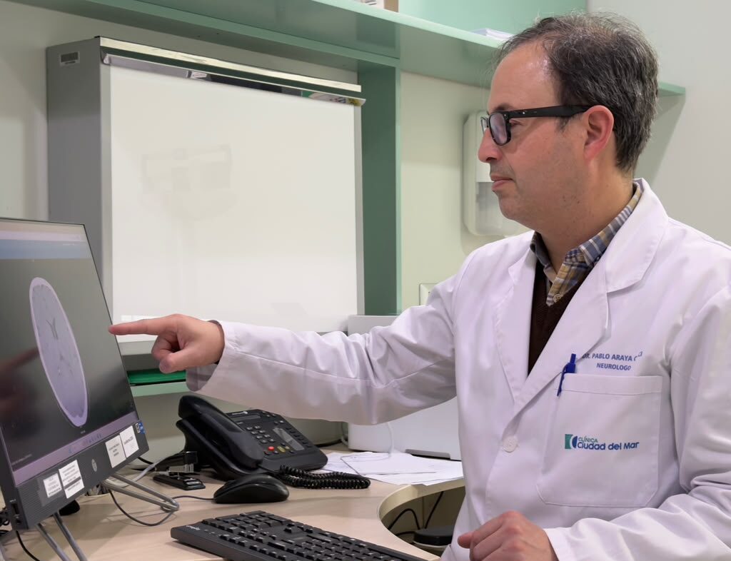 Día Mundial del Cerebro: Hasta el 90% de algunos ACV podrían prevenirse
